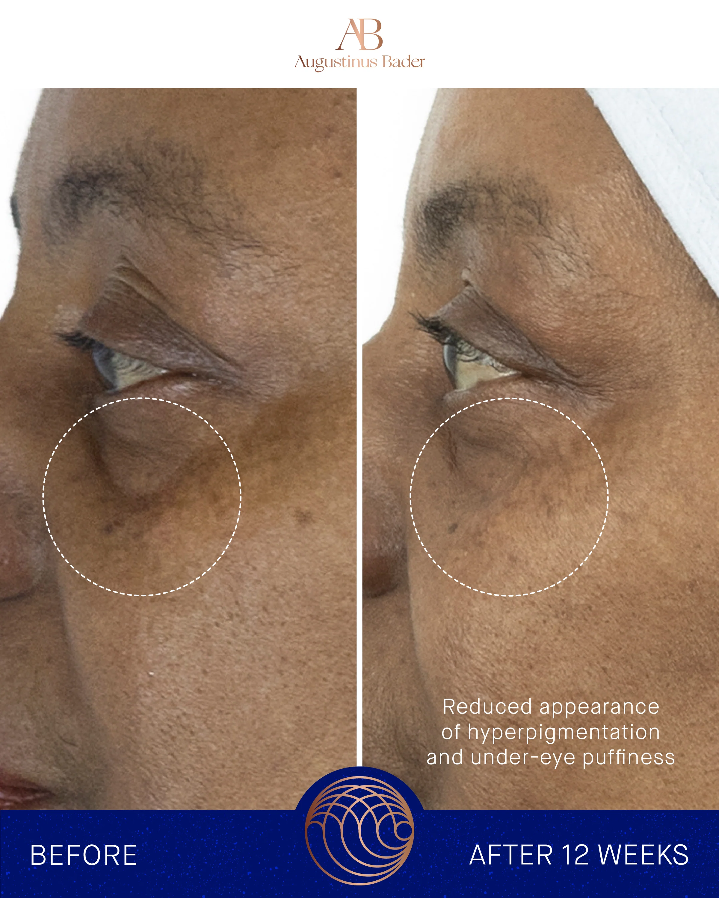 Augustinus Bader The Eye Cream Full Set - Image 8